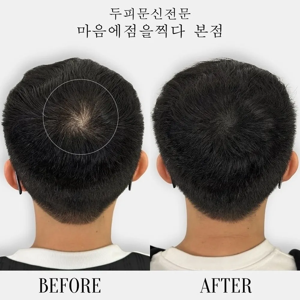 정수리 두피문신 전후 사례