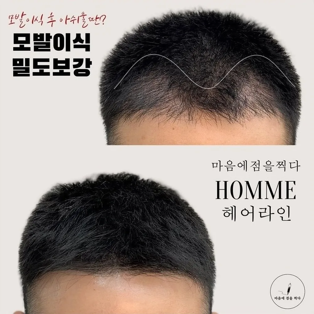 헤어라인 두피문신 사례