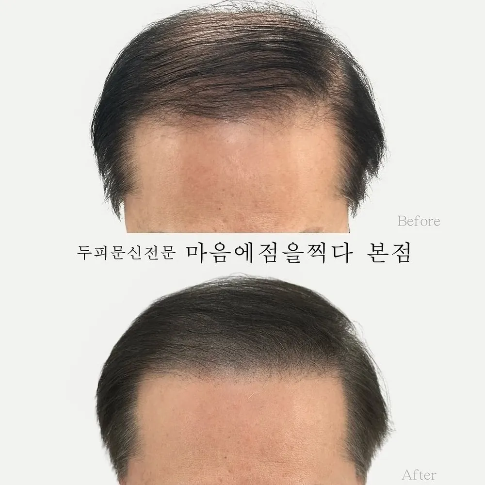 M자 두피문신 사례