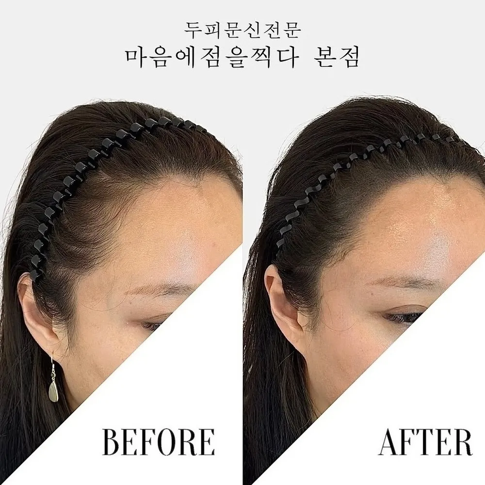 헤어라인 두피문신 전후 사례